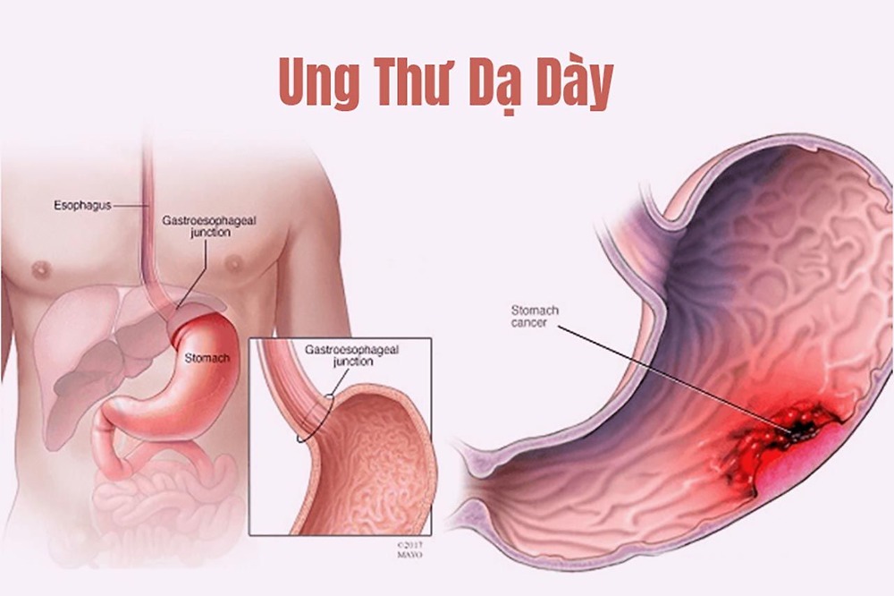 NGUYÊN NHÂN BỆNH UNG THƯ DẠ DÀY