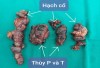 Nhân một trường hợp phẫu thuật cắt toàn bộ tuyến giáp, nạo vét hạch cổ triệt căn hai bên trong đều trị ung thư tuyến giáp
