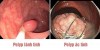 KHI NÀO CẦN TẦM SOÁT POLYP ĐẠI TRÀNG?