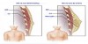 PHÌ ĐẠI TUYẾN VÚ Ở NAM