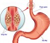 NỘI SOI PHẾ QUẢN ỐNG MỀM: NHỮNG ĐIỀU CẦN BIẾT