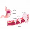 VAI TRÒ CỦA XÉT NGHIỆM CA 72- 4 TRONG TẦM SOÁT UNG THƯ DẠ DÀY