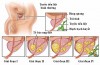 PSA TOÀN PHẦN VÀ PSA TỰ DO