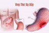 6 DẤU HIỆU CỦA UNG THƯ DẠ DÀY, NHIỀU NGƯỜI CÒN CHỦ QUAN