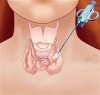 SINH THIẾT TỨC THÌ CÓ PHÁT HIỆN UNG THƯ TUYẾN GIÁP KHÔNG?