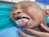 PHẪU THUẬT THÀNH CÔNG BỆNH NHÂN UNG THƯ LƯỠI - KẾT QUẢ GẮN KẾT TRÍ TUỆ TẬP THỂ