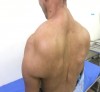 Bệnh “ Người gấu ” (MSL)