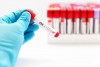 CEA-Xét nghiệm theo dõi hiệu quả điều trị ung thư đại trực tràng (Carcinoma Embryonic Antigen)