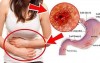 TẦM SOÁT UNG THƯ DẠ DÀY – NHỮNG ĐIỀU CẦN BIẾT