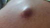 NANG DẠNG BIỂU BÌ (EPIDERMOID CYST)