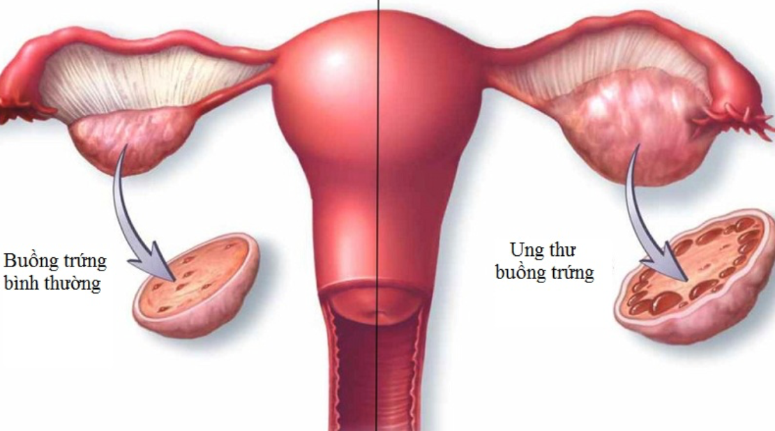Xét nghiệm CA12-5 trong tầm soát và theo dõi điều trị  ung thư buồng trứng