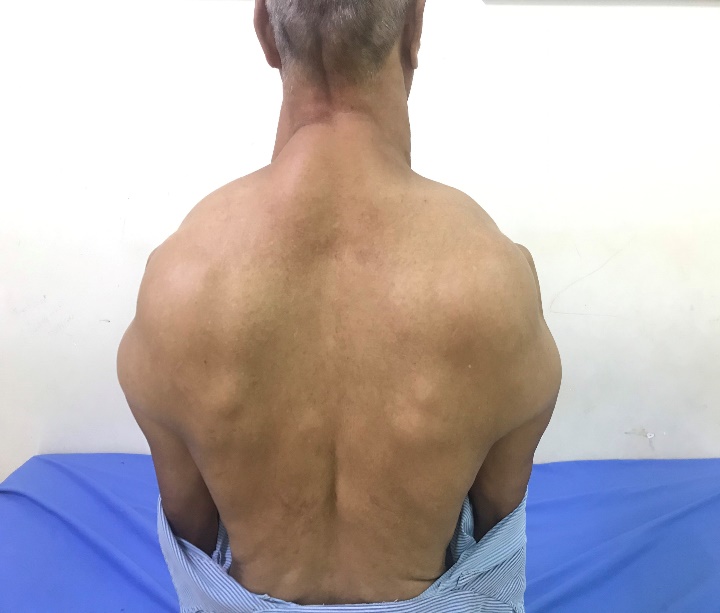 Báo cáo nhân 1 Case lâm sàng hiếm gặp: Bệnh Madelung – Bệnh “ Người gấu ” (MSL)